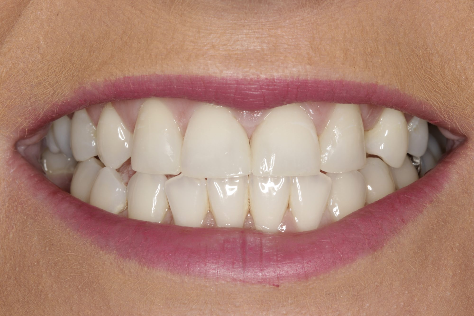 Achieving Pearly Whites: The Role of Diet in Teeth Whitening