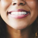 Understanding Veneers: A Journey into Minimally Invasive Dentistry